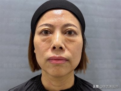 48岁眼袋手术失败!修复