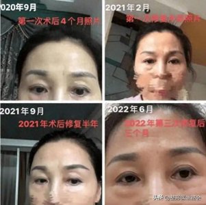 ​美容整成毁容？一女子“泪沟填充”失败，真实感受只有自己知道