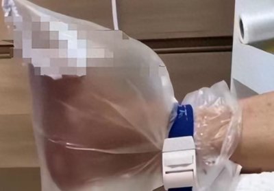 ​原来糖尿病足这么可怕，看完网友分享，吓得我再也不敢喝奶茶了