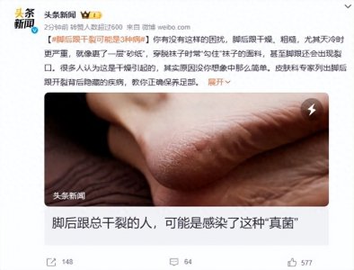 ​脚后跟干裂可能是3种病